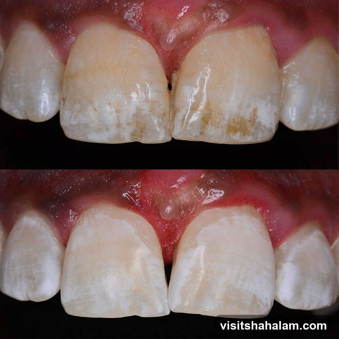 Before and After Dental Treatment