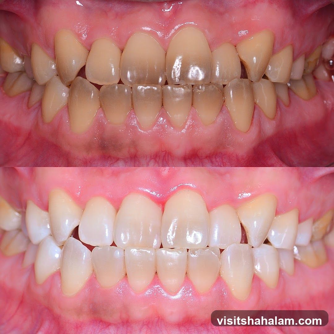 Before and After Teeth Whitening