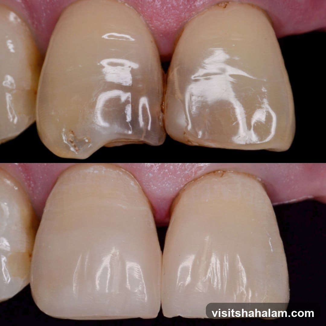 Dental Crowns Before and After