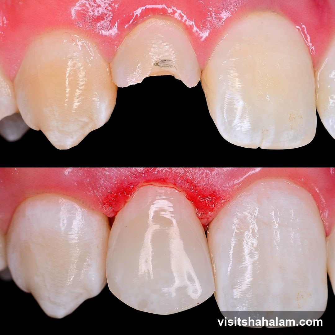 Dental Restoration