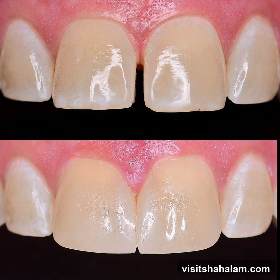 Dental Veneers