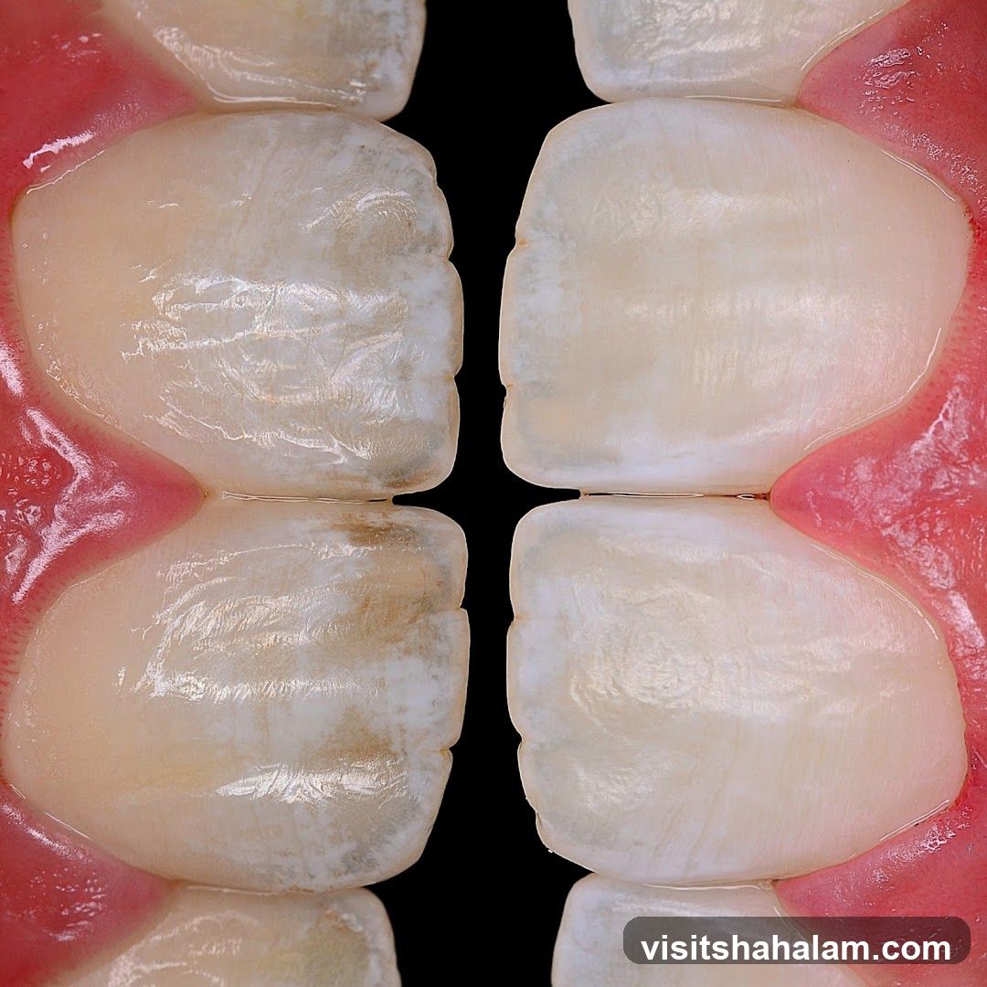 Close-up of Dental Crowns