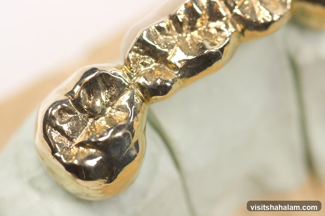 Gold Dental Crown