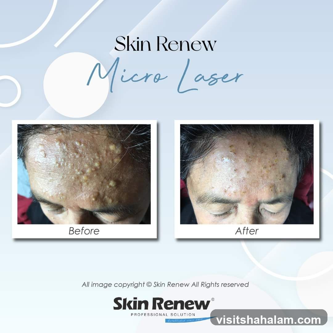 Skin Renew Micro Laser Before and After