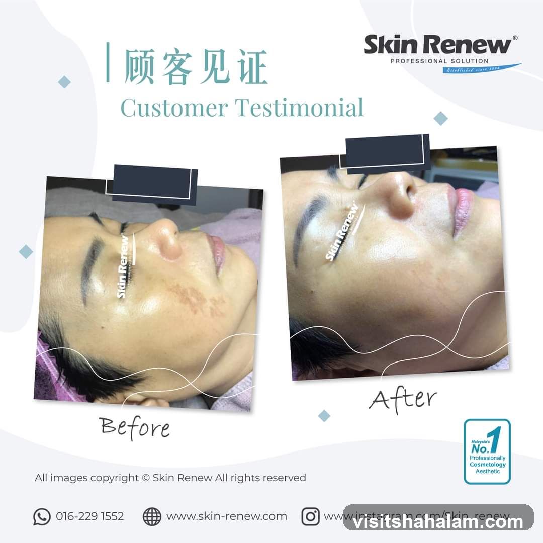 Skin Renew Customer Testimonial