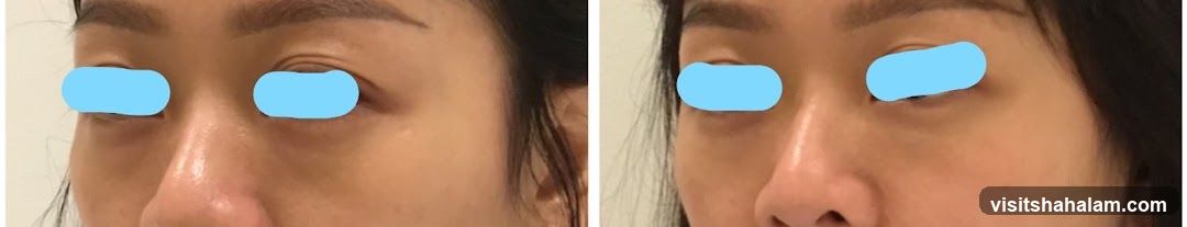 Before and After Eye Treatment