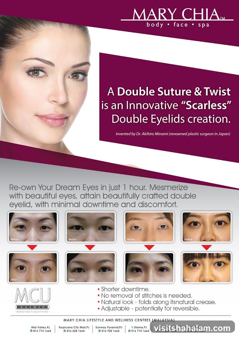 Mary Chia Double Eyelids Advertisement