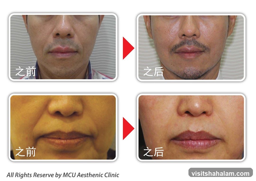 Before and After Cosmetic Procedure