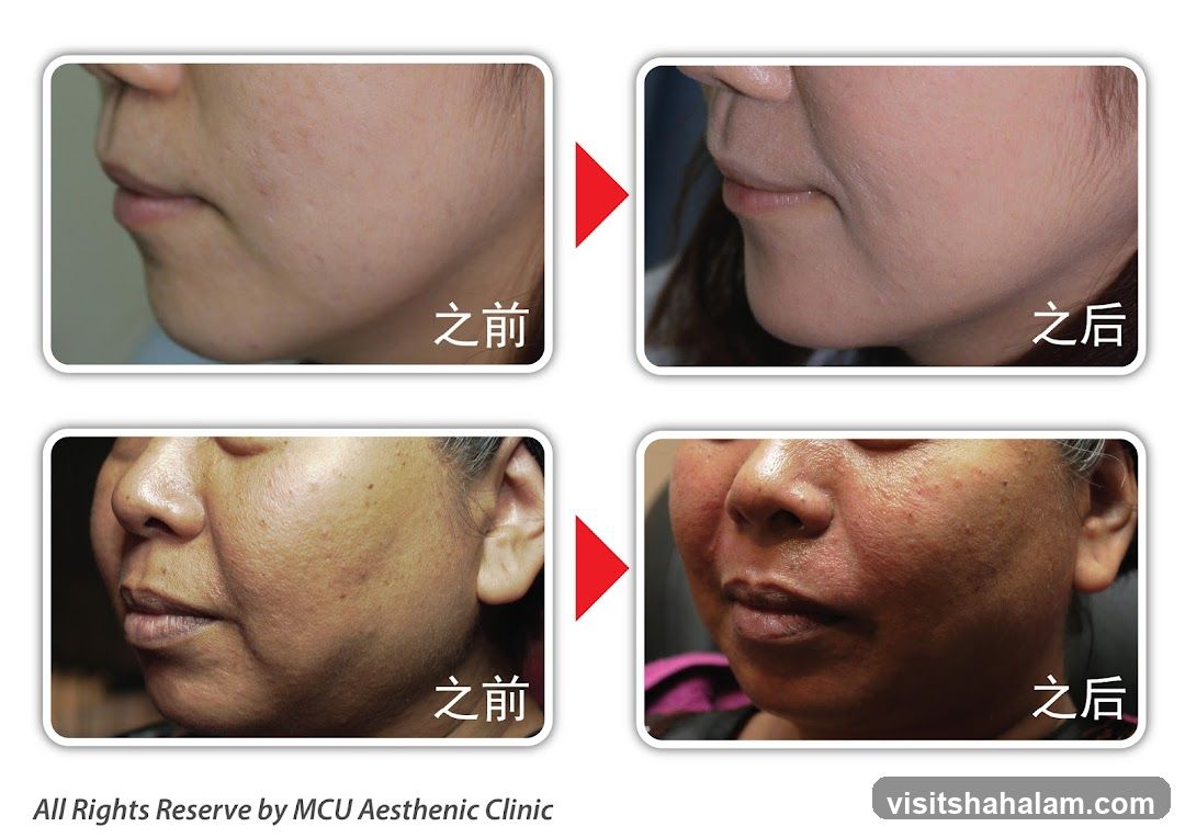 Before and After Cosmetic Treatment