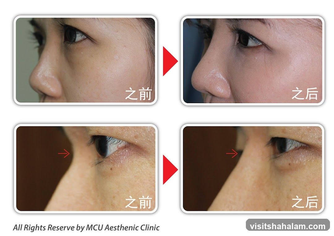 Before and After Cosmetic Procedure