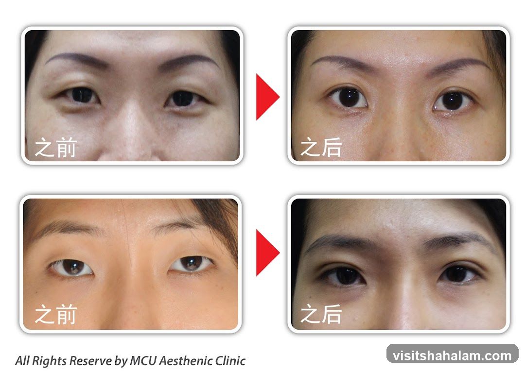 Before and After Eye Surgery